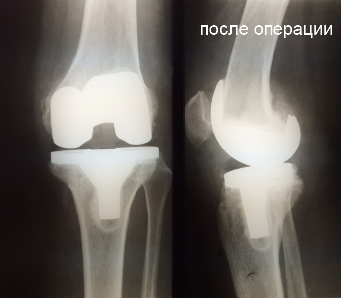 Базовый препарат для лечения артрита