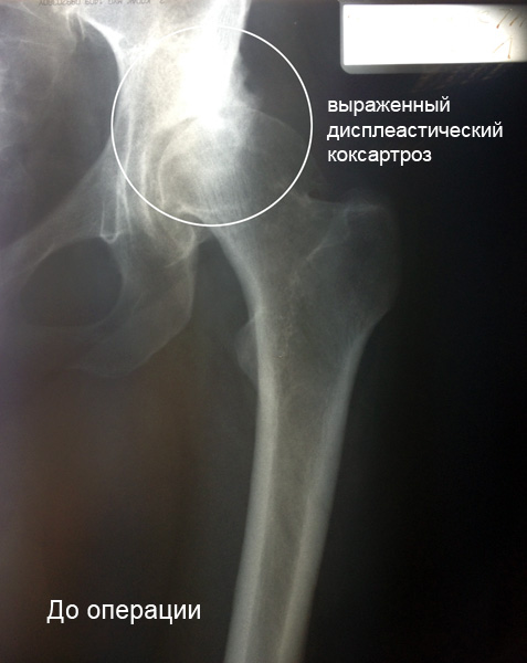 Двухсторонний диспластический коксартроз тазобедренных суставов височнонижнечелюстной сустав-сложный по классификации