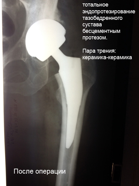 народная медицина, лечение суставов