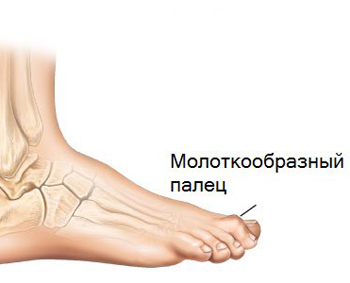 Молоткообразная деформация пальцев стопы